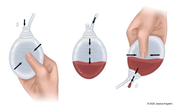 Jackson Pratt Dren (Closed Suction Wound Drain) - Görsel 2